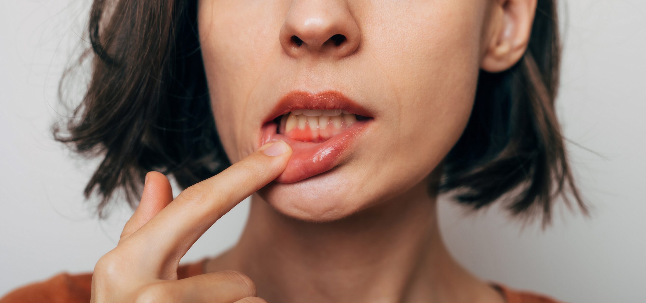 closeup of a woman pulling down her lower lip exposing inflamed gums, early signs of gum disease